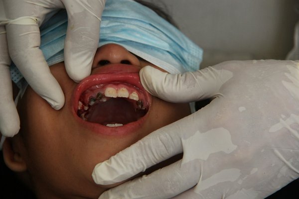 Prévenir les caries : alimentation et habitudes gagnantes pour un sourire sain